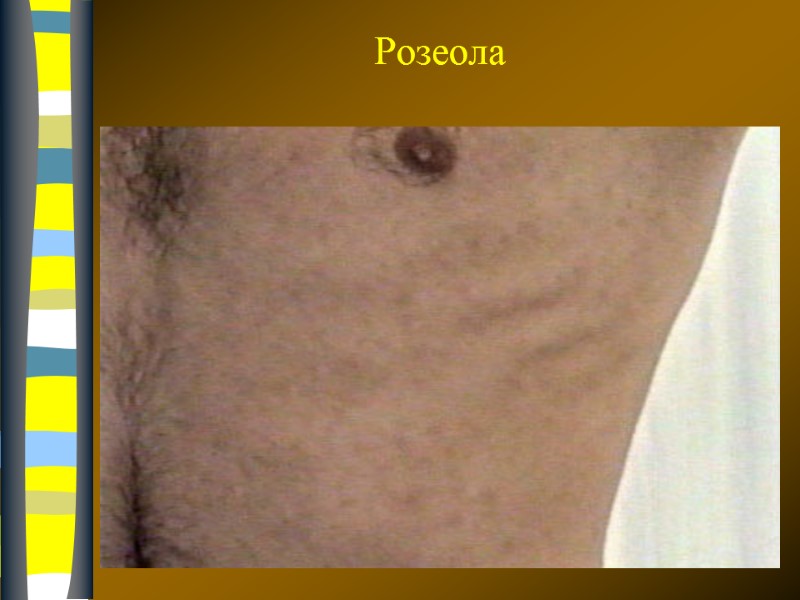 09.12.2017 Розеола